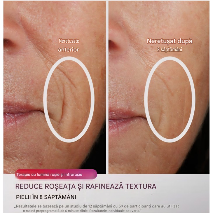 Masca faciala LED, Shark CryoGlow FW312EUPL, terapie cu lumină, răcire pentru zona ochilor, efect anti-aging, lumină roșie și albastră, alimentare USB-C, telecomandă, livrare 7-8 zile