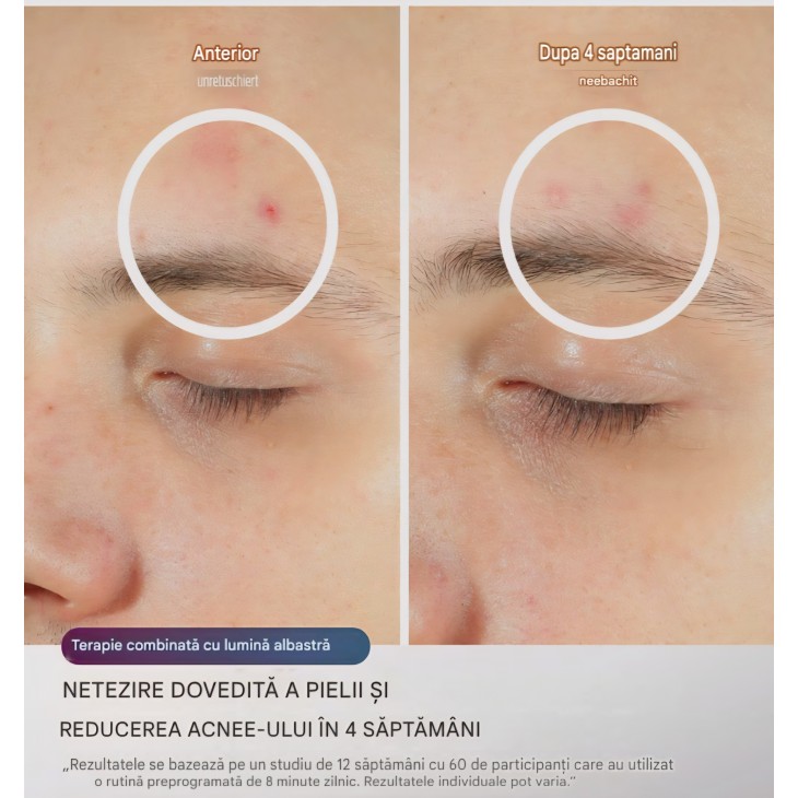 Masca faciala LED, Shark CryoGlow FW312EUPL, terapie cu lumină, răcire pentru zona ochilor, efect anti-aging, lumină roșie și albastră, alimentare USB-C, telecomandă, livrare 7-8 zile